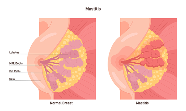 Mastitis